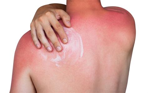 How long does it take for skin color to come back after sunburn?