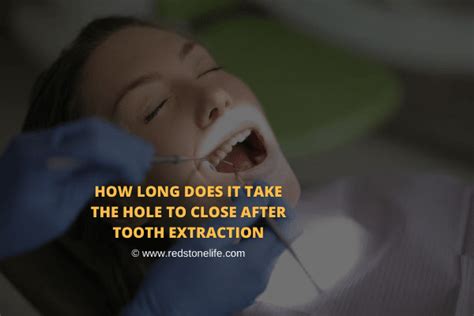 How long does it take for tooth extraction hole to close?