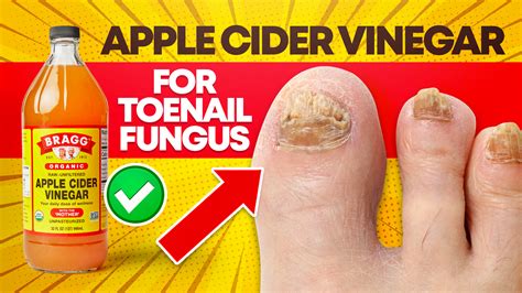 How long does it take for vinegar to kill fungus?