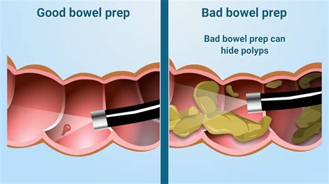 How long does it take to empty your bowels after colonoscopy prep?