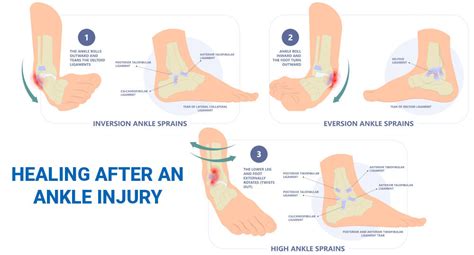 How long does it take to recover from a foot injury?