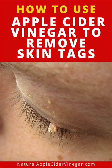 How long does it take to remove a skin tag with vinegar?