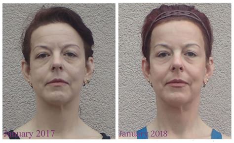 How long does it take to see results from face yoga?