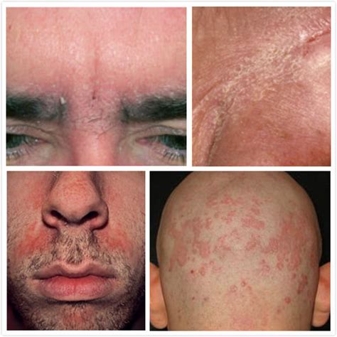 How long does it take to treat seborrheic dermatitis on face?