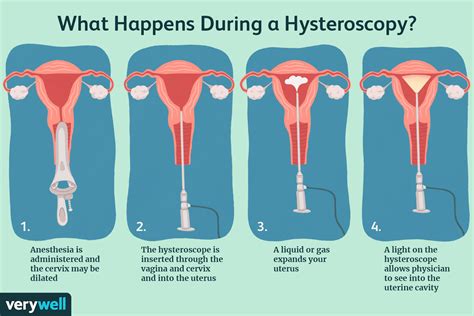 How long does it take your uterus to heal after polyp removal?