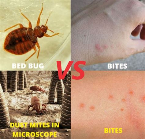 How long does mite bites last?