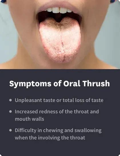 How long does oral thrush last?
