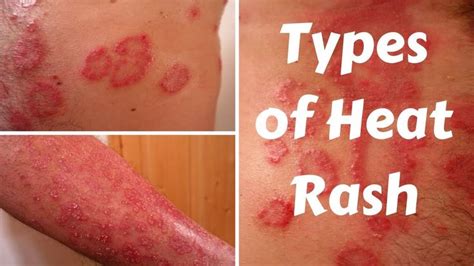How long does pad rash last?