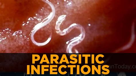 How long does parasite pain last?