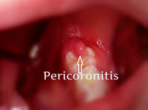 How long does pericoronitis last without antibiotics?