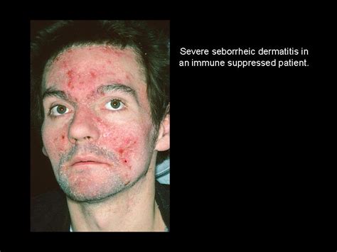 How long does seborrheic dermatitis last on face?