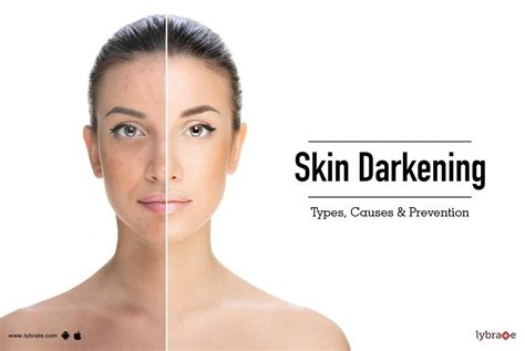 How long does skin darkening last?