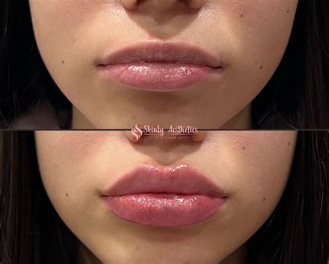 How long does the Russian lip technique last?