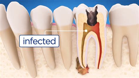 How long is a root canal warranty?