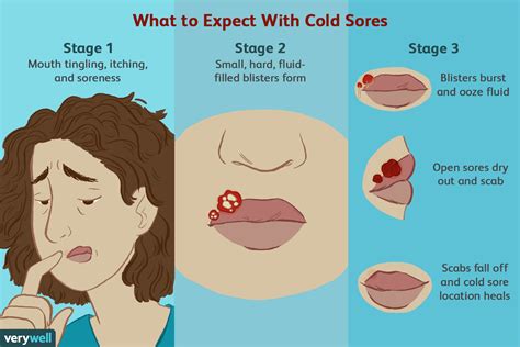 How long should I leave salt on a cold sore?