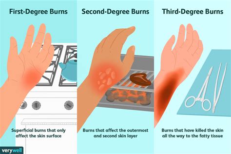 How long should a burn be wet for?