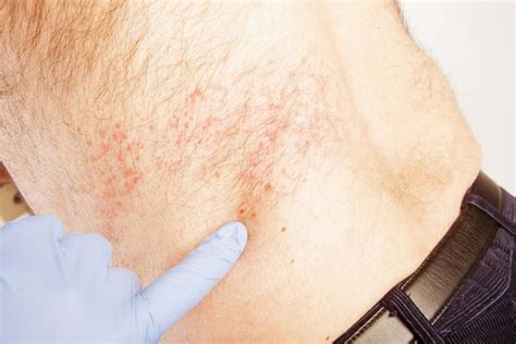How long should a rash last before seeing a doctor?