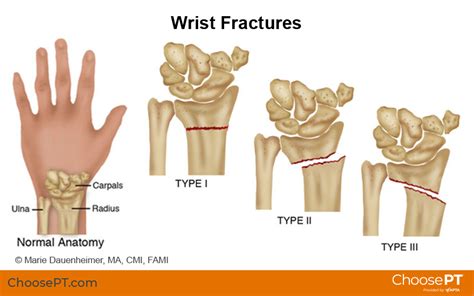 How long should you rest a broken wrist?