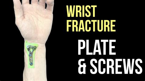 How long to recover from broken wrist with plate and screws?