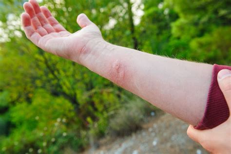 How long will a burn sting for?