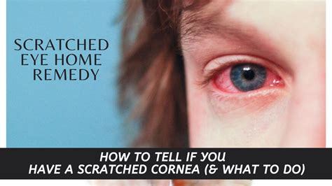 How long will a scratched eye hurt?