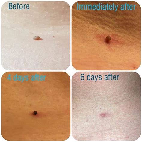 How long will it take for skin tag to fall off?