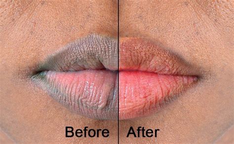 How long will it take my lips to lighten up after quitting smoking?