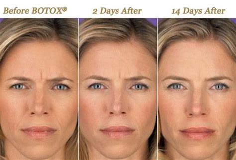How many days after Botox can you get waxed?