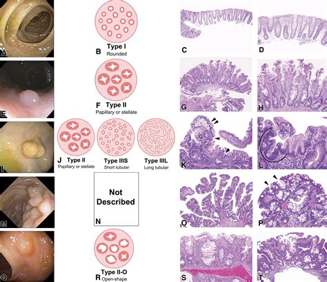 How many is a lot of polyps?