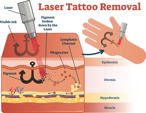 How many laser treatments does it take to remove a tattoo?