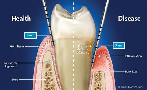 How many mm is periodontitis?