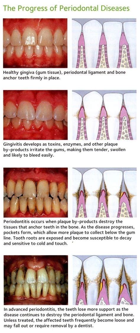 How many people have advanced periodontitis?