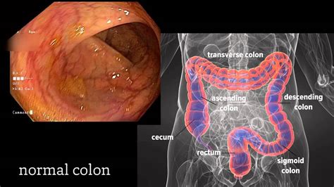 How many polyps are too many in a colonoscopy?