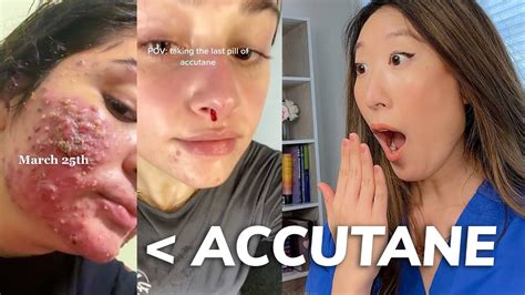 How many times can you go on Accutane in your life?