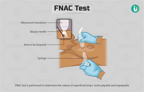 How many types of FNAC test are there?