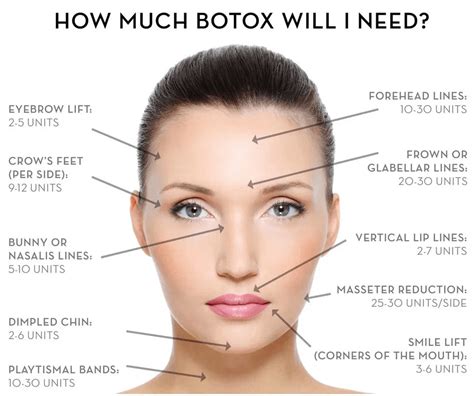 How many units of Botox for 11 lines?