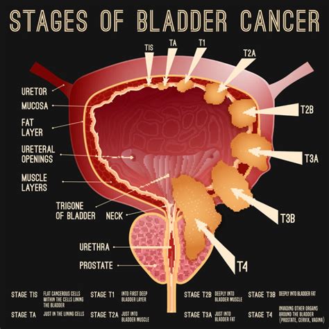 How many years can you have bladder cancer without knowing?