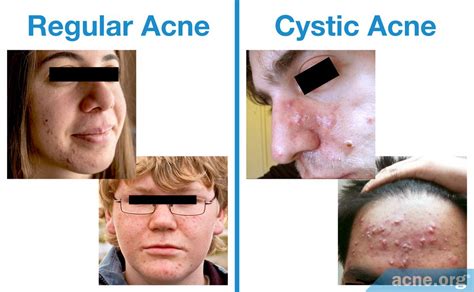 How much acne is normal?