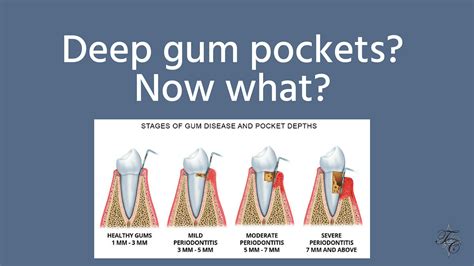 How much can gum pockets be reduced?