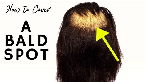 How much does it cost to fix bald spot?