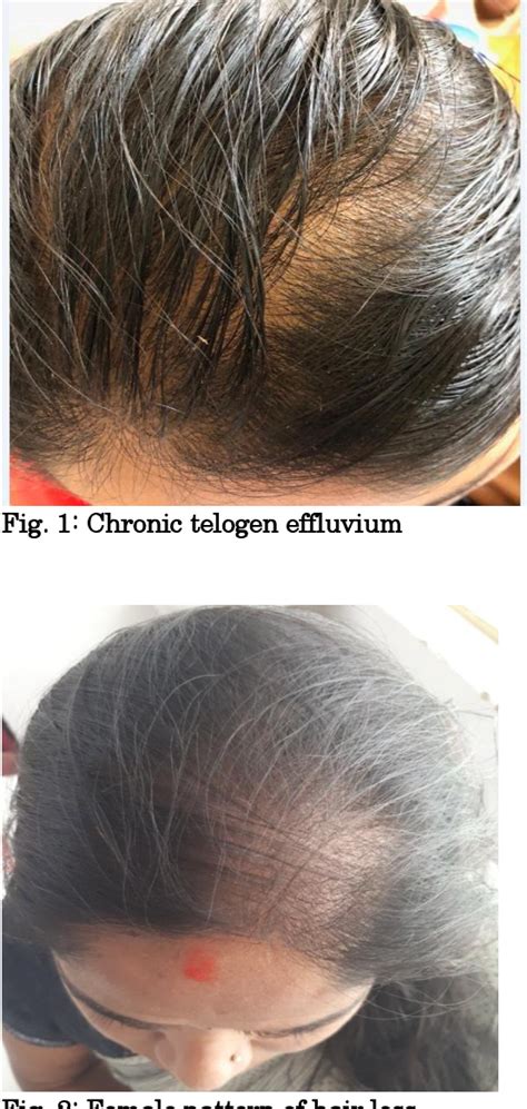 How much ferritin to stop hair loss?