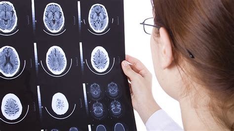 How often do MS patients see their neurologist?