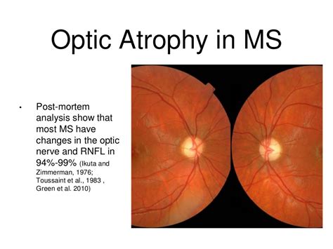 How often does optic neuritis occur with MS?