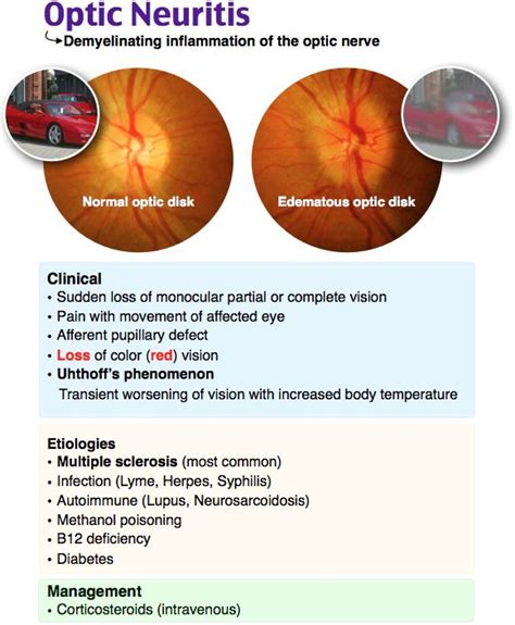 How often does optic neuritis recur?