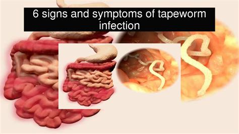 How painful are tapeworms?
