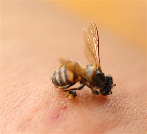 How painful is a bee?