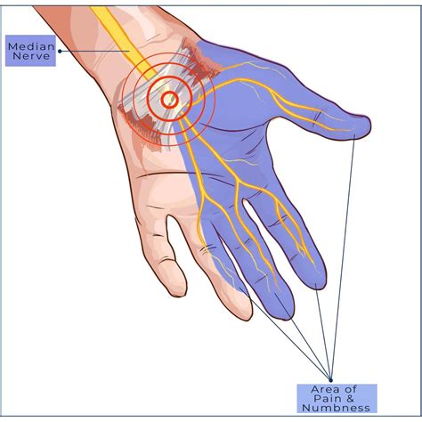How painful is carpal tunnel?