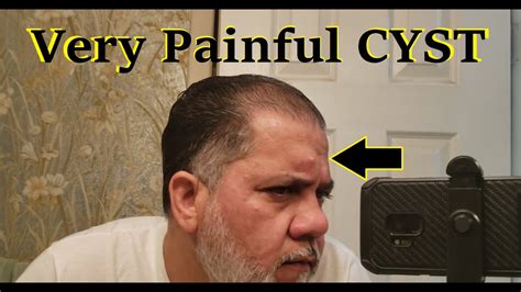 How painful is it to pop a cyst?