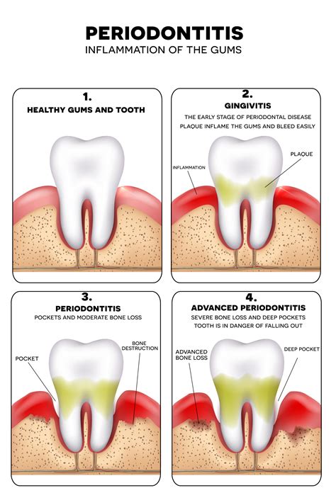 How painful is periodontitis?