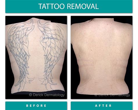 How painful is removing a tattoo?